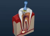 7 Warning Signs You May Need a Root Canal Treatment
