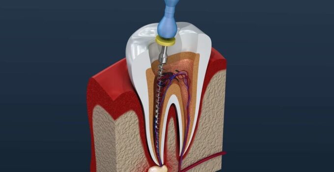 7 Warning Signs You May Need a Root Canal Treatment