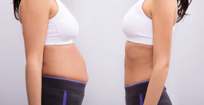 Liposuction Vs. Tummy Tuck – Which Procedure Is Better