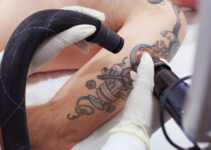 What is the Best Tattoo Removal Studio in Melbourne, AU