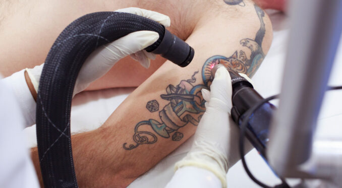 What is the Best Tattoo Removal Studio in Melbourne, AU - Haaretz daily -  Info & News Magazine 2023