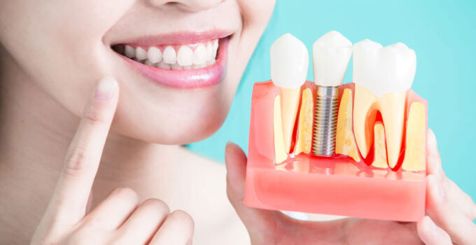 Pros and Cons of Getting Dental Implants Abroad