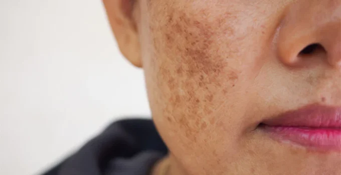 What Is Melasma? And What You Can Do To Treat It