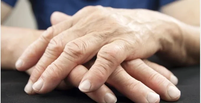 Different Types of Arthritis, Self Care, and Medical Intervention