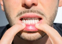 How To Improve Your Underbite Without Surgical Intervention