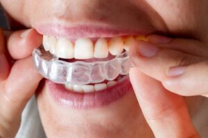 Invisalign Treatment: A Guide to a Straighter Smile and Improved Oral Health