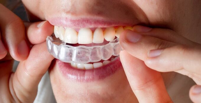 Invisalign Treatment: A Guide to a Straighter Smile and Improved Oral Health
