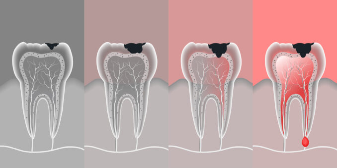 Types of Cavities